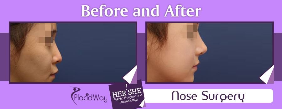 Before and After Images Nose Surgery in Seoul, South Korea
